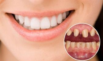 Địa chỉ bọc răng sứ uy tín nhất Tây Ninh
