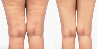 Bài tập giúp bạn đánh tan tình trạng da sần vỏ cam (cellulite) trong 2 tuần