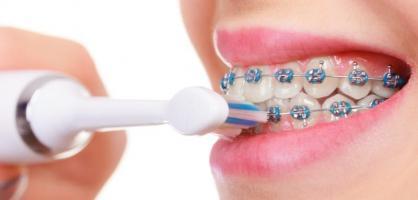 Bàn chải đánh răng cho răng niềng tốt nhất hiện nay