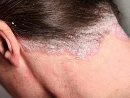Cách chữa bệnh vẩy nến hiệu quả nhất không cần dùng thuốc