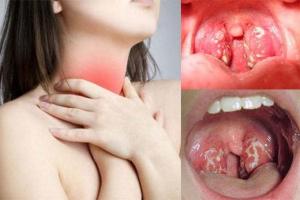 Cách chữa viêm amidan tại nhà hiệu quả nhất