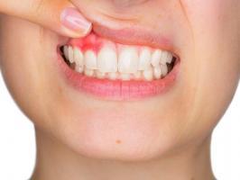 Cách chữa viêm lợi hiệu quả nhất tại nhà