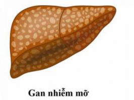 Cách điều trị gan nhiễm mỡ bằng dân gian tại nhà hiệu quả nhất
