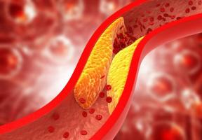 Cách kiểm soát mỡ máu hiệu quả nhất