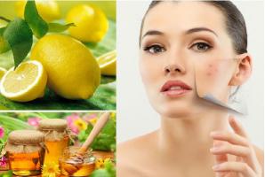 Cách trị vết thâm do mụn tại nhà đơn giản hiệu quả nhất