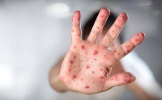 Dấu hiệu tay chân miệng ở trẻ bố mẹ đừng bỏ qua