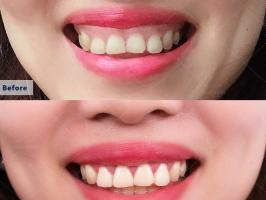 Địa chỉ chữa cười hở lợi uy tín nhất Hải Phòng