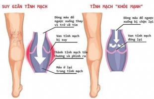 Địa chỉ khám và điều trị suy giãn tĩnh mạch uy tín nhất Hà Nội
