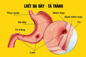 Địa chỉ khám và điều trị viêm loét dạ dày tốt nhất TP. Hồ Chí Minh