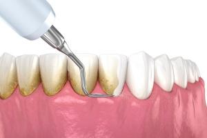 Địa chỉ lấy cao răng tại Quy Nhơn, Bình Định tốt nhất