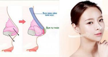 Địa chỉ nâng mũi đẹp và an toàn nhất tỉnh Quảng Trị
