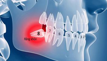 Địa chỉ nhổ răng khôn uy tín nhất tại Bình Dương