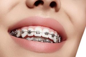 Địa chỉ niềng răng uy tín nhất Bạc Liêu
