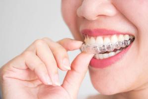 Địa chỉ niềng răng uy tín nhất Cần Thơ