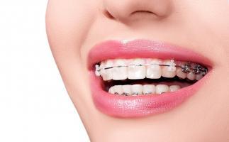 Địa chỉ niềng răng uy tín nhất Quận 9, TP. HCM
