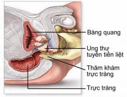 Địa chỉ tầm soát ung thư tuyến tiền liệt chất lượng nhất Hà Nội