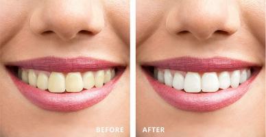Địa chỉ tẩy trắng răng uy tín nhất tỉnh Thái Bình