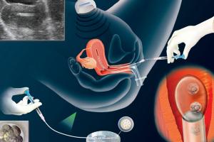 Địa chỉ thụ tinh nhân tạo (IUI) uy tín nhất Hà Nội