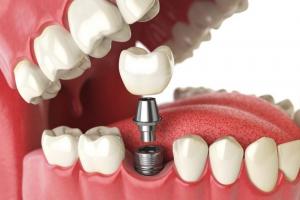 Địa chỉ trồng răng implant uy tín nhất TP. Hạ Long, Quảng Ninh