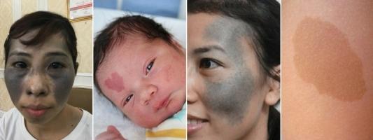Địa chỉ xóa chàm bớt bẩm sinh hiệu quả nhất Hà Nội