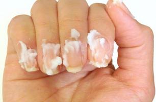 Kem trị nấm móng hiệu quả nhất hiện nay