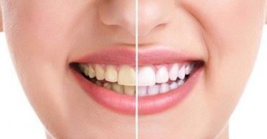 Cách lấy cao răng tại nhà hiệu quả nhất