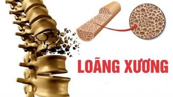 Lưu ý quan trọng nhất về bệnh loãng xương