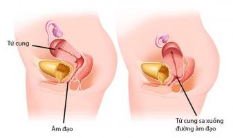 Lưu ý quan trọng nhất về sa bàng quang