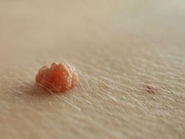 Miếng dán trị mụn cóc hiệu quả nhất