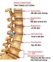 Nguyên nhân, triệu chứng bệnh thoái hóa cột sống