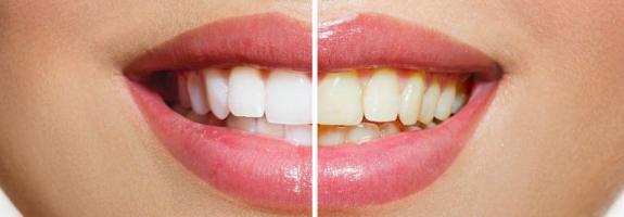 Địa chỉ tẩy trắng răng uy tín nhất tỉnh Ninh Thuận