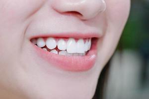 Địa chỉ niềng răng uy tín nhất tỉnh Kon Tum