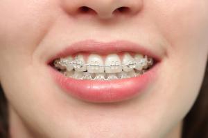 Nha khoa niềng răng mắc cài sứ dây trong uy tín nhất tại Đà Nẵng