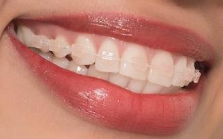 Nha khoa niềng răng mắc cài sứ dây trong uy tín nhất tỉnh Nghệ An