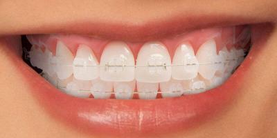 Nha khoa niềng răng mắc cài sứ dây trong uy tín nhất tỉnh Thừa Thiên Huế