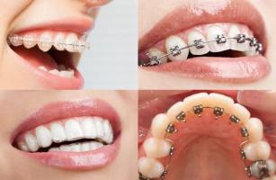 Nha khoa niềng răng trả góp uy tín nhất TP. HCM