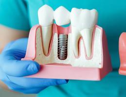 Địa chỉ trồng răng implant tốt nhất tỉnh Đắk Nông