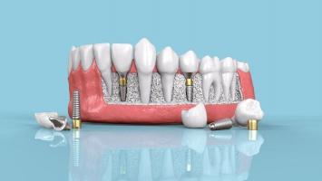 Nha khoa trồng răng implant uy tín nhất quận Phú Nhuận, TP. HCM