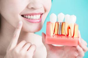 Nha khoa trồng răng uy tín nhất huyện Cần Giờ, TP. HCM