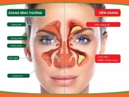 Nguyên liệu trị viêm xoang hiệu quả tại nhà từ thiên nhiên