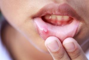 Sản phẩm trị nhiệt miệng cho bé hiệu quả mẹ nên biết