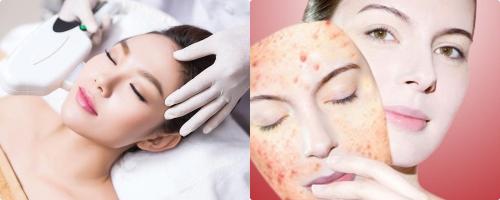Spa trị mụn hiệu quả nhất Long Thành, Đồng Nai