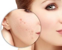 Spa trị mụn hiệu quả nhất TP. Đồng Hới, Quảng Bình