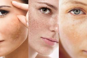 Spa trị nám tốt nhất tỉnh Quảng Ngãi