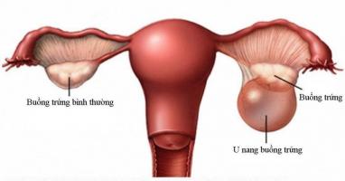 Thực phẩm chức năng hỗ trợ điều trị u nang buồng trứng hiệu quả nhất