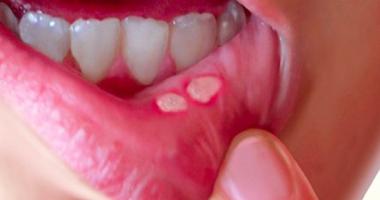 Viên uống hỗ trợ điều trị nhiệt miệng hiệu quả nhất