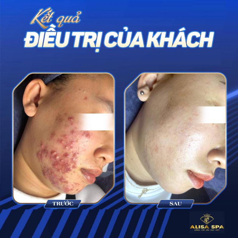 Alisa Spa Thanh Hóa
