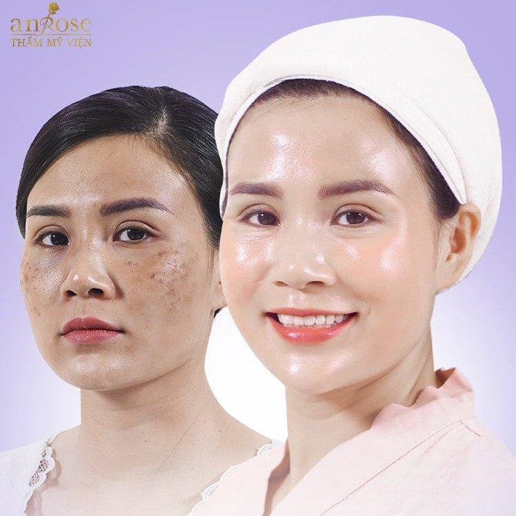 Anrose Spa Bắc Ninh