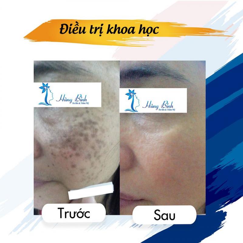 Da liễu thẩm mỹ Hùng Bình - BS CKII. Nguyễn Bá Hùng