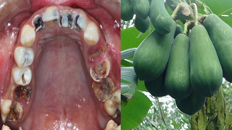 Bài thuốc điều trị sâu răng bằng nhựa đu đủ
